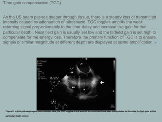 Time gain compensation (TGC)
As the US beam passes deeper through tissue, there is a steady loss of transmitted
intensity caused by attenuation of ultrasound. TGC toggles amplify the weak
returning signal proportionately to the time delay and increase the gain for that
particular depth . Near field gain is usually set low and the farfield gain is set high to
compensate for the energy loss. Therefore the primary function of TGC is to ensure
signals of similar magnitude at different depth are displayed at same amplification. [20]
Figure 8: In this mid-esophageal four-chamber view, the TGC toggles at the level of the ventricles have been manipulated to illustrate the high gain at that
particular depth (arrow)
 