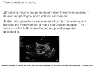 Two-dimensional imaging
2D imaging helps to image the heart motion in real-time enabling
detailed morphological and functional assessment .
It also helps quantitative assessment of cardiac dimensions and
provides the framework for M-mode and Doppler imaging. The
various control buttons used to get an optimal image are
described in.
Figure 6: Mid-esophageal AV short axis view. LA- Left atrium; NCC- Non-coronary cusp; LCC- Left coronary cusp; RCC- Right coronary cusp; TV- Tricuspid valve; P
 