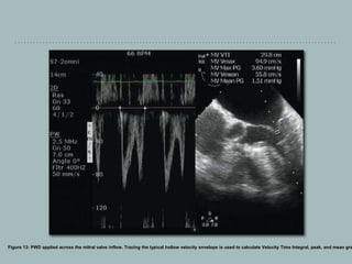 Figure 13: PWD applied across the mitral valve inflow. Tracing the typical hollow velocity envelope is used to calculate Velocity Time Integral, peak, and mean gra
 