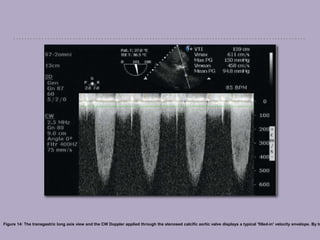 Figure 14: The transgastric long axis view and the CW Doppler applied through the stenosed calcific aortic valve displays a typical 'filled-in' velocity envelope. By tr
 