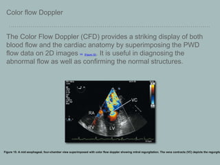 Color flow Doppler
The Color Flow Doppler (CFD) provides a striking display of both
blood flow and the cardiac anatomy by superimposing the PWD
flow data on 2D images [29] [Figure 15]. It is useful in diagnosing the
abnormal flow as well as confirming the normal structures.
Figure 15: A mid esophageal, four-chamber view superimposed with color flow doppler showing mitral regurgitation. The vena contracta (VC) depicts the regurgita
 