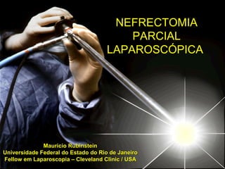 Mauricio Rubinstein Universidade Federal do Estado do Rio de Janeiro Fellow em Laparoscopia – Cleveland Clinic / USA NEFRECTOMIA  PARCIAL  LAPAROSCÓPICA  