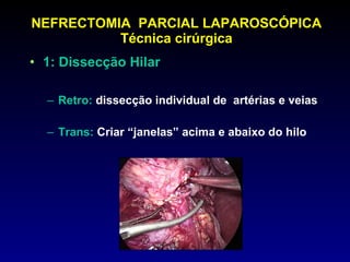 NEFRECTOMIA  PARCIAL LAPAROSCÓPICA Técnica cirúrgica 1: Dissecção Hilar Retro:  dissecção individual de  artérias e veias Trans:  Criar “janelas” acima e abaixo do hilo 