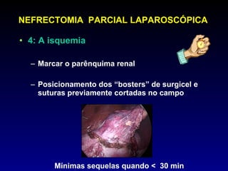 NEFRECTOMIA  PARCIAL LAPAROSCÓPICA 4: A isquemia  Marcar o parênquima renal Posicionamento dos “bosters” de surgicel e suturas previamente cortadas no campo Mínimas sequelas quando <  30 min 