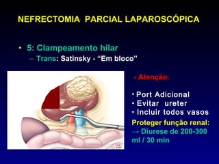 NEFRECTOMIA  PARCIAL LAPAROSCÓPICA 5: Clampeamento hilar Trans : Satinsky - “Em bloco” - Atenção: Port Adicional  Evitar  ureter Incluir todos vasos Proteger função renal: ->  Diurese de 200-300 ml / 30 min 
