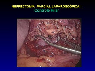 NEFRECTOMIA  PARCIAL LAPAROSCÓPICA  : Controle Hilar 