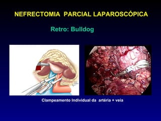 Clampeamento Individual da  artéria + veia NEFRECTOMIA  PARCIAL LAPAROSCÓPICA Retro: Bulldog  