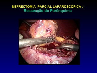 NEFRECTOMIA  PARCIAL LAPAROSCÓPICA  : Ressecção do Parênquima 