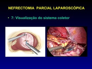 7: Visualização do sistema coletor NEFRECTOMIA  PARCIAL LAPAROSCÓPICA 