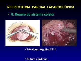 8: Reparo do sistema coletor  NEFRECTOMIA  PARCIAL LAPAROSCÓPICA 2-0 vicryl, Agulha CT-1  Sutura contínua 