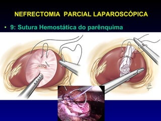 9: Sutura Hemostática do parênquima NEFRECTOMIA  PARCIAL LAPAROSCÓPICA 