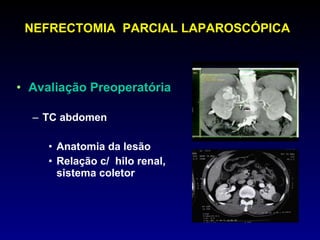 NEFRECTOMIA  PARCIAL LAPAROSCÓPICA Avaliação Preoperatória TC abdomen Anatomia da lesão Relação c/  hilo renal, sistema coletor 