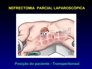 NEFRECTOMIA  PARCIAL LAPAROSCÓPICA Posição do paciente - Transperitoneal 