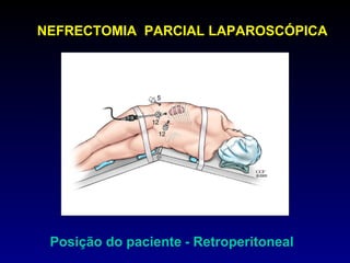 NEFRECTOMIA  PARCIAL LAPAROSCÓPICA Posição do paciente   - Retroperitoneal 