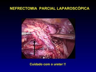 NEFRECTOMIA  PARCIAL LAPAROSCÓPICA Cuidado com o ureter !! 