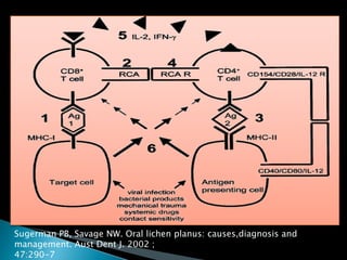 Sugerman PB, Savage NW. Oral lichen planus: causes,diagnosis and
management. Aust Dent J. 2002 ;
47:290-7
 