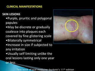CLINICAL MANIFESTATIONS
SKIN LESIONS
•Purple, pruritic and polygonal
papules
•May be discrete or gradually
coalesce into plaques each
covered by fine glistering scale
•Bilaterally symmetrical
•Increase in size if subjected to
any irritation
•Usually self limiting unlike the
oral lesions lasting only one year
or less
Text book of oral medicine-burkete‟s 11th edition
 