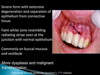 Severe form with extensive
degeneration and separation of
epithelium from connective
tissue
Faint white zone resembling
radiating striae seen at the
junction with normal epithelium
Commonly on buccal mucosa
and vestibule
More dysplasia and malignant
transformation
Text book of oral medicine-burkete‟s 11th edition
 