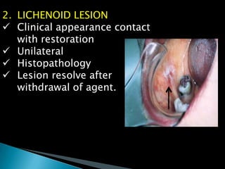 2. LICHENOID LESION
 Clinical appearance contact
with restoration
 Unilateral
 Histopathology
 Lesion resolve after
withdrawal of agent.
 