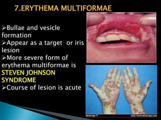 7.ERYTHEMA MULTIFORMAE
Bullae and vesicle
formation
Appear as a target or iris
lesion
More severe form of
erythema multiformae is
STEVEN JOHNSON
SYNDROME
Course of lesion is acute
 