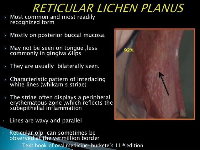 oral lichen planus case presentation ppt