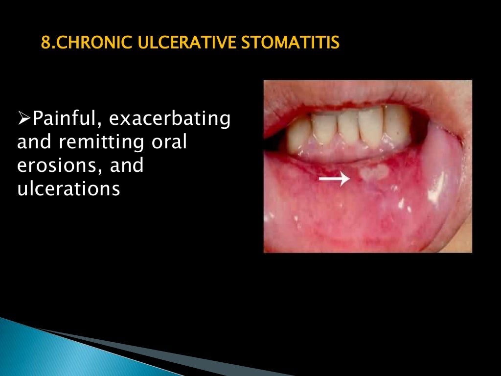oral lichen planus presentation