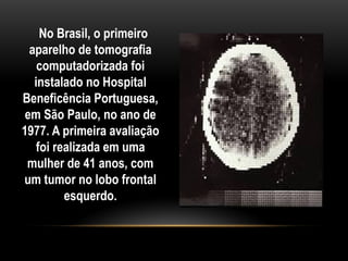 No Brasil, o primeiro
aparelho de tomografia
computadorizada foi
instalado no Hospital
Beneficência Portuguesa,
em São Paulo, no ano de
1977. A primeira avaliação
foi realizada em uma
mulher de 41 anos, com
um tumor no lobo frontal
esquerdo.
 