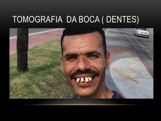 TOMOGRAFIA DA BOCA ( DENTES)
 
