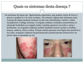 Quais os sintomas desta doença ?

Os sintomas de lupus são ligeiramente diferentes, que podem variar de leves a
  graves e podem ir e vir com o tempo.. No entanto, alguns dos sintomas mais
  comuns do lúpus incluem inchaço ou dor nas articulações ( artrite ), febre
  inexplicável, e fadiga extrema. A erupção cutânea vermelha característica (o
  chamado borboleta ou erupção malar ) podem aparecer em todo o nariz e
  bochechas. As erupções cutâneas podem também ocorrer na face e orelhas,
  braços, ombros, tórax e mãos. Porque muitas pessoas com lúpus são sensíveis à
  luz solar, erupções cutâneas frequentemente primeiramente desenvolver ou
  piorar após a exposição ao sol.
 