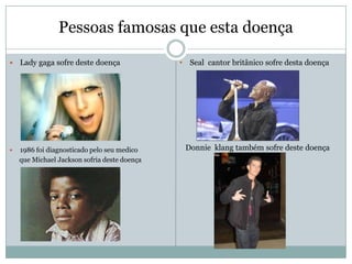 Pessoas famosas que esta doença

   Lady gaga sofre deste doença              • Seal cantor britânico sofre desta doença




   1986 foi diagnosticado pelo seu medico     Donnie klang também sofre deste doença
    que Michael Jackson sofria deste doença
 
