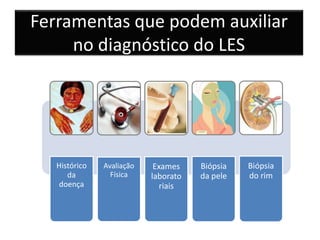 Ferramentas que podem auxiliar
no diagnóstico do LES
Histórico
da
doença
Avaliação
Física
Exames
laborato
riais
Biópsia
da pele
Biópsia
do rim
 