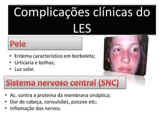 • Eritema característico em borboleta;
• Urticaria e bolhas;
• Luz solar.
• Ac. contra a proteína da membrana sináptica;
• Dor de cabeça, convulsões, psicose etc;
• Inflamação dos nervos.
Complicações clínicas do
LES
 
