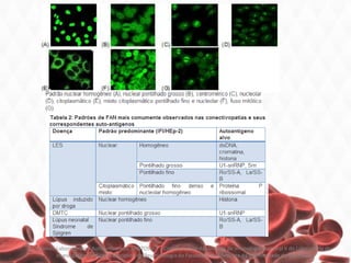 Exames Laboratoriais - Autoanticorpos, SANTOS V T - Coordenadora da Unidade de Imunologia Humoral II do Laboratório de
Investigação Médica da Disciplina de Reumatologia da Faculdade de Medicina da Universidade de São Paulo
 