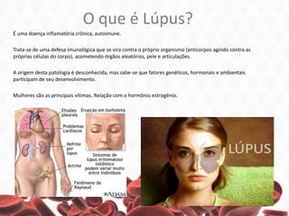 O que é Lúpus?
É uma doença inflamatória crônica, autoimune.
Trata-se de uma defesa imunológica que se vira contra o próprio organismo (anticorpos agindo contra as
próprias células do corpo), acometendo órgãos aleatórios, pele e articulações.
A origem desta patologia é desconhecida, mas sabe-se que fatores genéticos, hormonais e ambientais
participam de seu desenvolvimento.
Mulheres são as principais vítimas. Relação com o hormônio estrogênio.
 