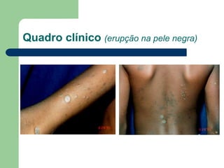 Quadro clínico (erupção na pele negra)
 