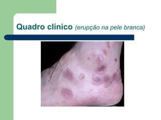 Quadro clínico (erupção na pele branca)
 