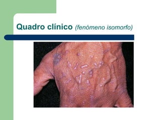 Quadro clínico (fenómeno isomorfo)
 