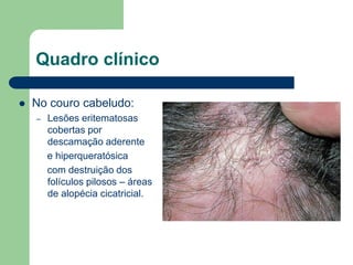 Quadro clínico
 No couro cabeludo:
– Lesões eritematosas
cobertas por
descamação aderente
e hiperqueratósica
com destruição dos
folículos pilosos – áreas
de alopécia cicatricial.
 