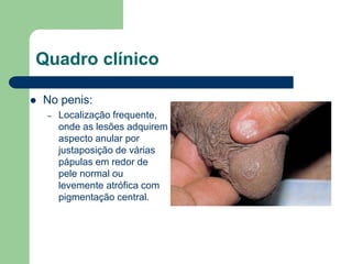 Quadro clínico
 No penis:
– Localização frequente,
onde as lesões adquirem
aspecto anular por
justaposição de várias
pápulas em redor de
pele normal ou
levemente atrófica com
pigmentação central.
 