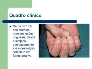 Quadro clínico
 Cerca de 10%
dos doentes
revelam lesões
ungueais, desde
o simples
adelgaçamento
até a destruição
completa em
forma erosiva.
 