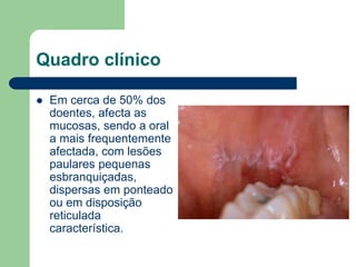 Quadro clínico
 Em cerca de 50% dos
doentes, afecta as
mucosas, sendo a oral
a mais frequentemente
afectada, com lesões
paulares pequenas
esbranquiçadas,
dispersas em ponteado
ou em disposição
reticulada
característica.
 