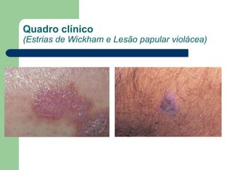 Quadro clínico
(Estrias de Wickham e Lesão papular violácea)
 