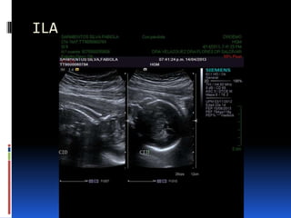 Ila Normal Valoracion de Líquido amniótico por Ultrasonido | PPTX