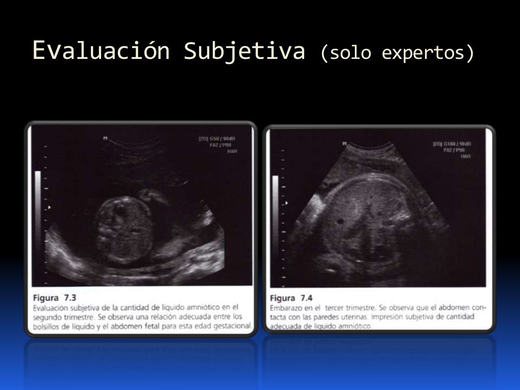 Líquido Amniótico Ultrasonido Segundo Trimestre Tiras Reactivas