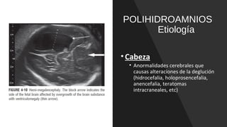 POLIHIDROAMNIOS
Etiología
•Cabeza
• Anormalidades cerebrales que
causas alteraciones de la deglución
(hidrocefalia, holoprosencefalia,
anencefalia, teratomas
intracraneales, etc)
 