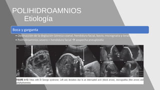 POLIHIDROAMNIOS
Etiología
 