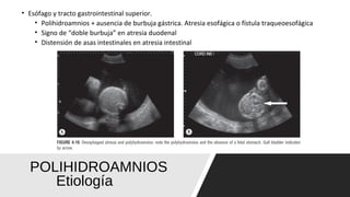 POLIHIDROAMNIOS
Etiología
• Esófago y tracto gastrointestinal superior.
• Polihidroamnios + ausencia de burbuja gástrica. Atresia esofágica o fístula traqueoesofágica
• Signo de “doble burbuja” en atresia duodenal
• Distensión de asas intestinales en atresia intestinal
 