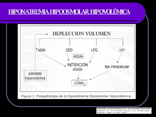 HIPONATREMIA HIPOOSMOLAR HIPOVOLÉMICA 