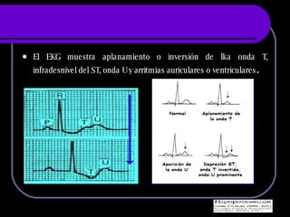 El EKG muestra aplanamiento o inversi ón de lka onda T, infradesnivel del ST, onda U y arritmias auriculares o ventriculares . 