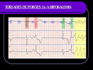 TORSADES DE POINTES 2o A HIPOKALEMIA 